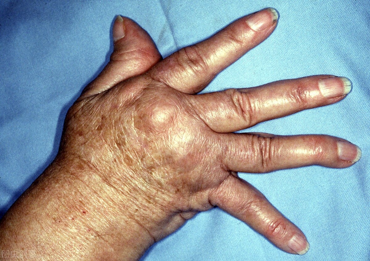 风湿类疾病怎么治疗,风湿瘤是什么症状