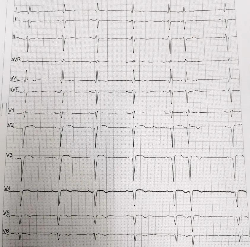 85岁老人心脏堵塞,77岁老人冠脉狭窄放支架还是搭桥