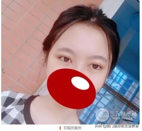 纳米无痕埋线双眼皮需不需要拆线,纳米无痕双眼皮动画操作过程视频