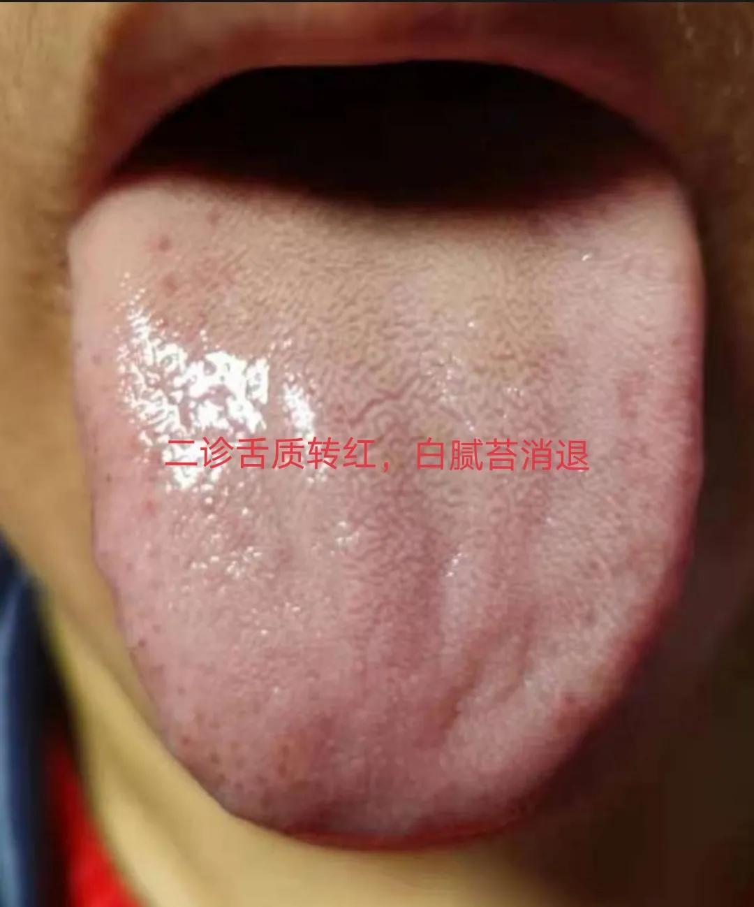 中风后遗症中医针灸治疗,中风后遗症中医治疗一例