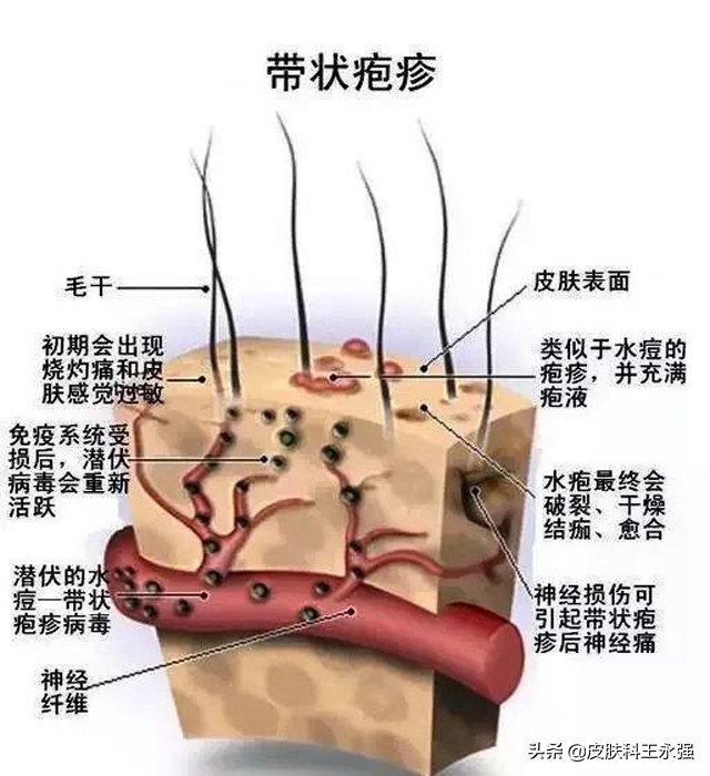 得了带状疱疹可能是什么病的征兆,警惕带状疱疹72小时内必须处理