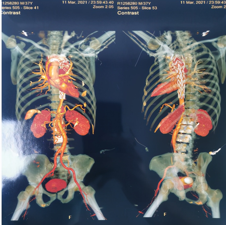 高血压引起的动脉夹层破裂死亡,高血压引起的主动脉夹层抢救