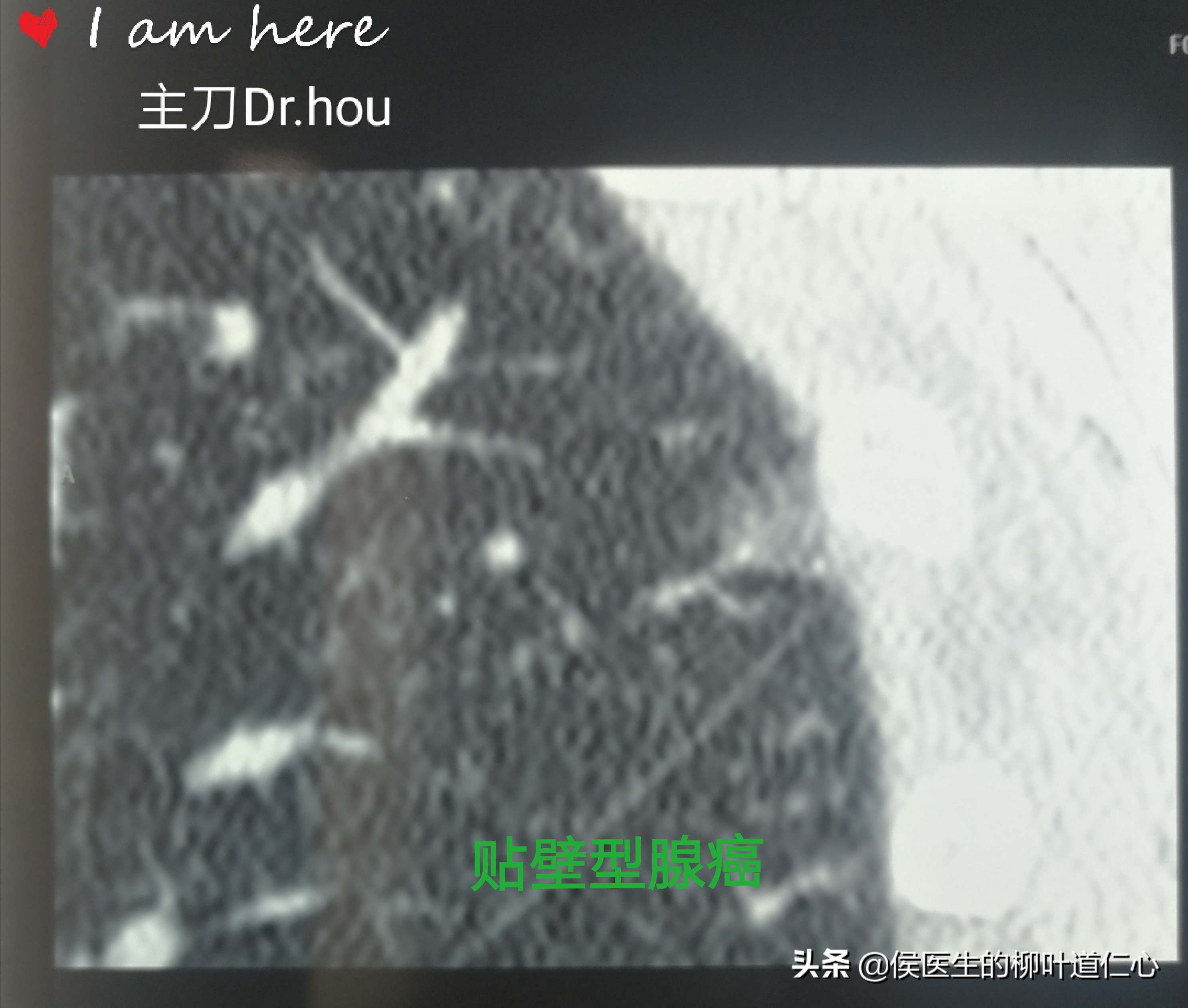 肺结节0.8厘米需手术吗,肺结节0期能治好吗