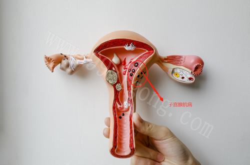 子宫肌瘤和子宫腺肌症区别是什么,什么是子宫肌瘤伴有腺肌症