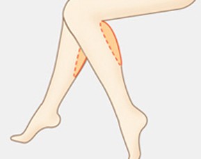 大小腿吸脂半个月小腿一碰就痛,小腿吸脂可以瘦几厘米