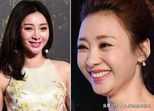 注射肉毒素脸部变化,肉毒素可以改变大小脸吗