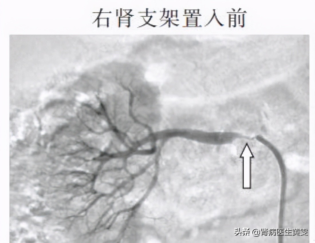 女性肌酐不稳定是什么原因,女肌酐高怎么才能退下去