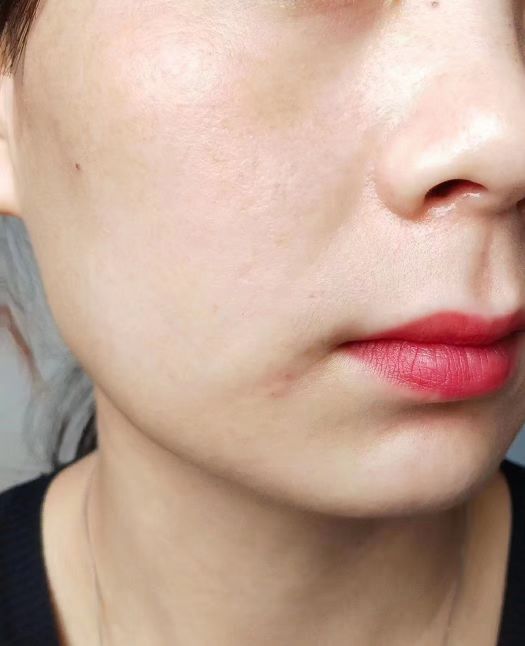 甜甜专业祛斑祛痘,甜甜祛斑直播间