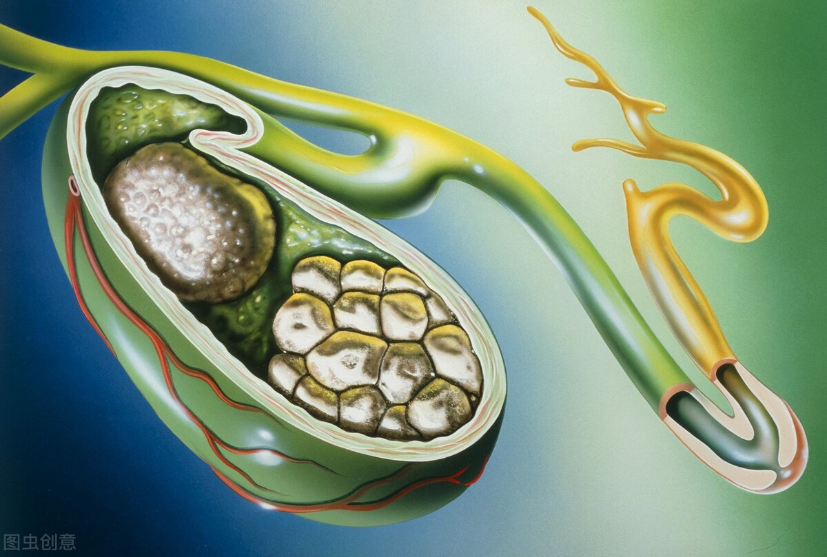 胆囊结石的危害和治疗方法,胆囊结石多大需要治疗