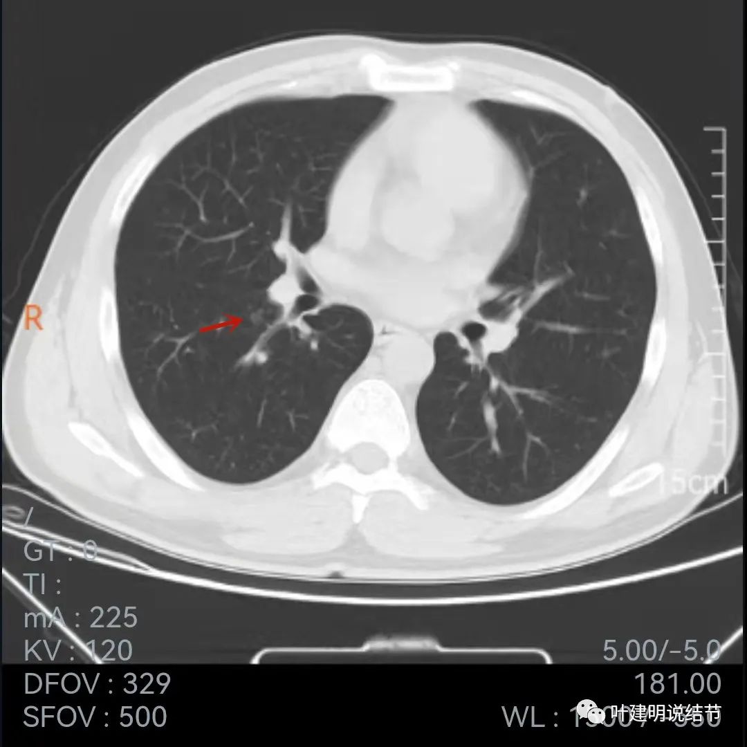 问诊分析：存在了4年的实性结节会不会是肺癌？