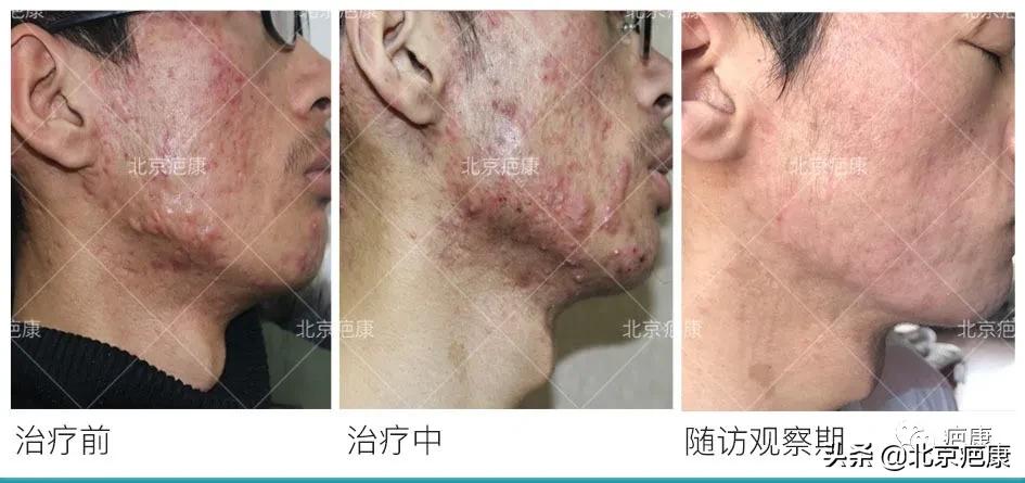 同位素照射治疗瘢痕疙瘩,同位素s90治疗瘢痕疙瘩