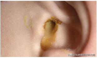 为什么有人耳朵流油,为什么耳朵老是油油的