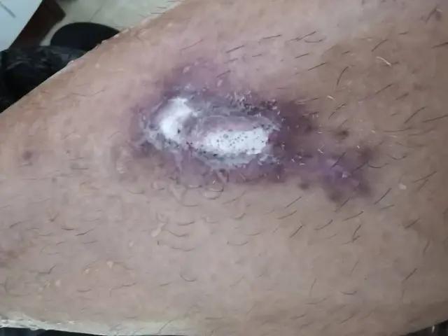 双氧水洗伤口导致周边红肿,伤口结痂感染用双氧水可以杀菌吗