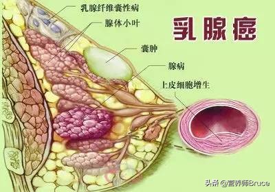 什么人容易乳腺癌,什么人易得乳腺癌