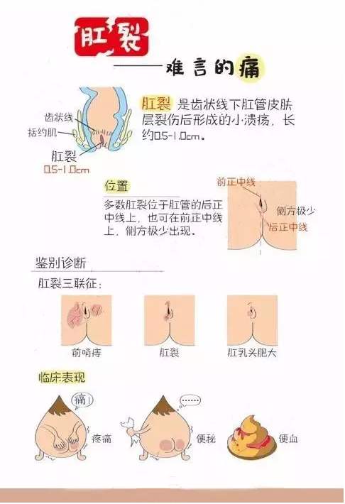 肛裂手术后痊愈的症状,肛裂有痒的症状怎么治