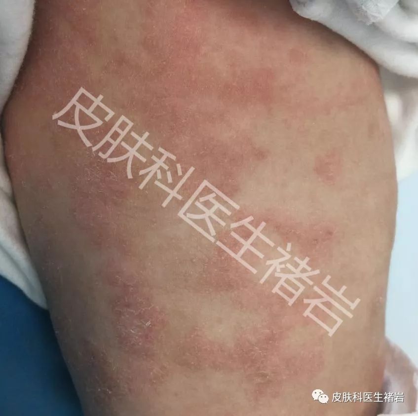 湿疹到底长什么样,手脚湿疹长什么样