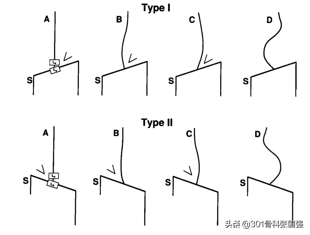 髋关节置换术后长短腿如何康复,髋关节置换术后的长短腿怎样训练