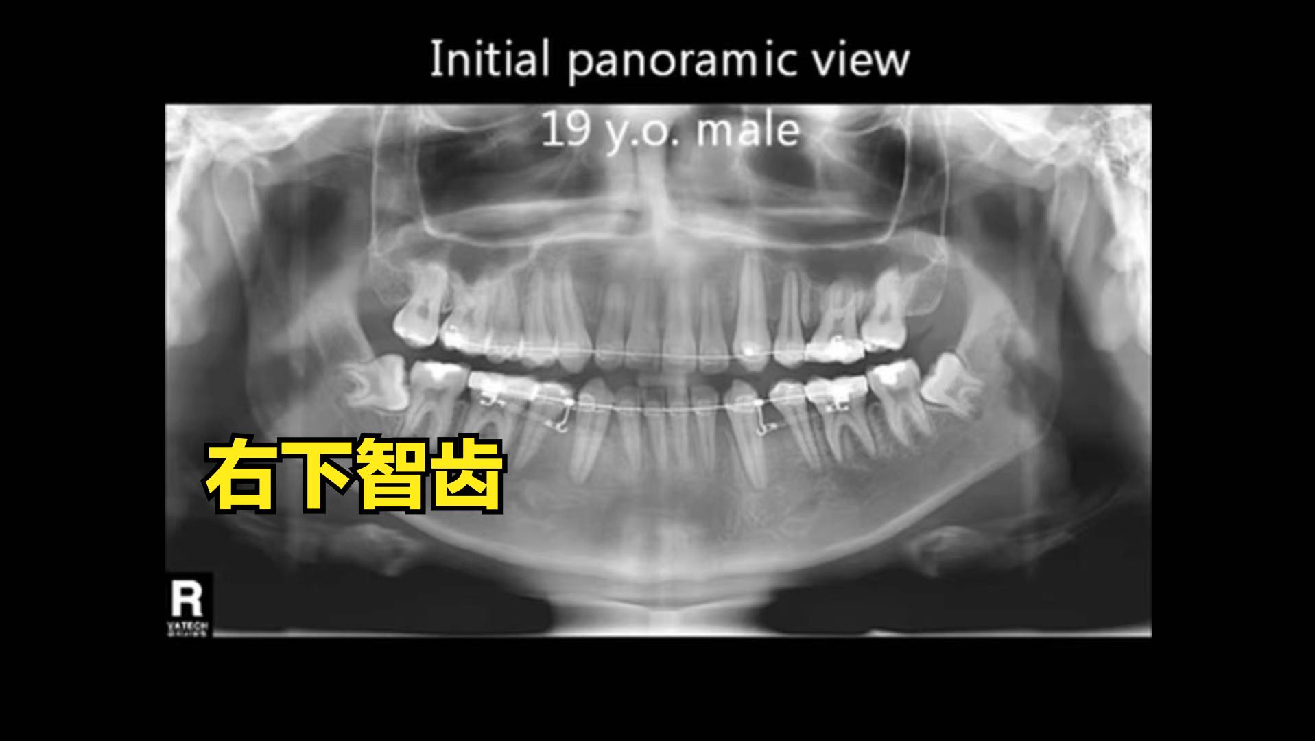 下颌阻生智齿拔除要流多少血,下颌低位水平阻生牙拔除图解