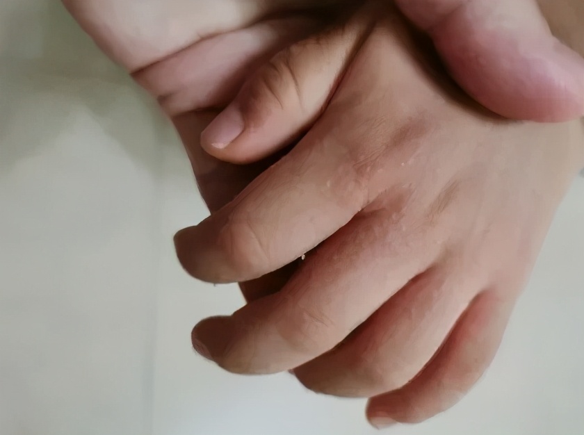 手上长一片小疙瘩还痒是怎么回事,天一热手上就起一层小疙瘩还很痒