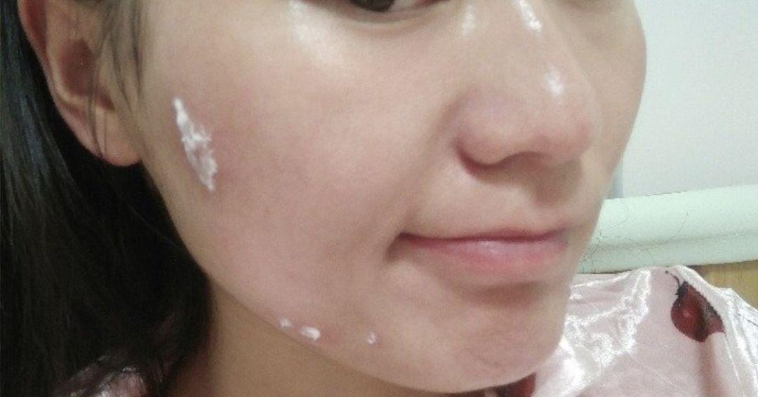 超好用的祛痘膏便宜,有没有好用的祛痘膏推荐女孩子