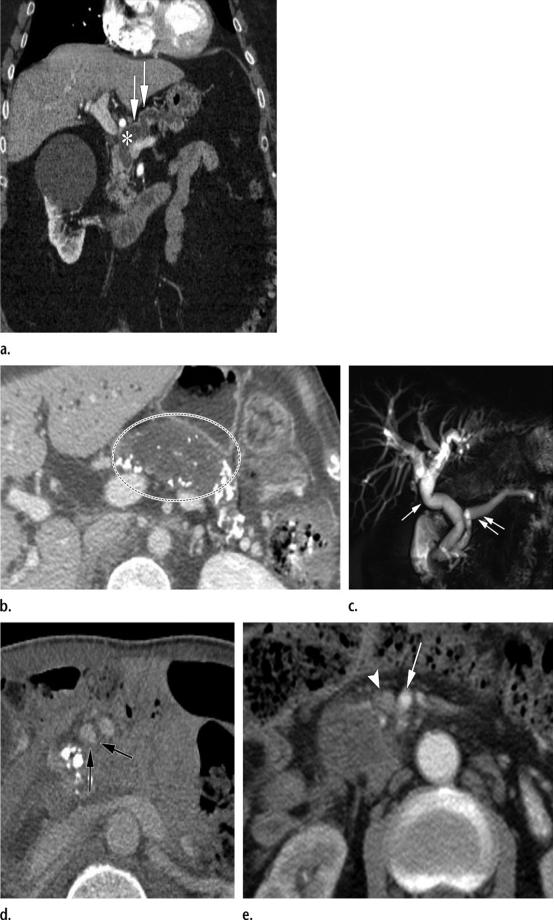 急性胰腺炎和慢性胰腺有什么症状,胰腺炎合并胰腺肿物