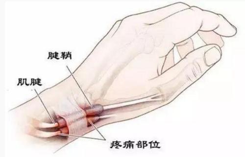 几个动作预防腱鞘炎(妈妈手),准妈妈必看