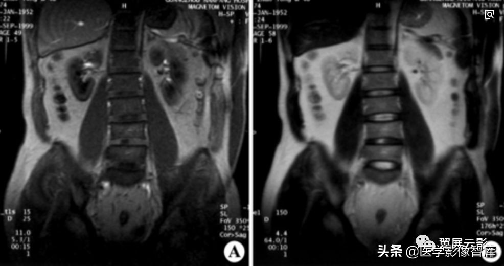 泌尿系统26种症状,泌尿系统的各疾病的体征汇总