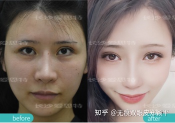 开扇双眼皮6毫米宽吗,双眼皮7.5毫米宽吗