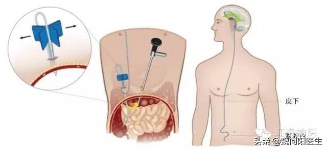 脑出血后脑子里血满了还能治吗,脑出血患者脑子恢复挺好能醒吗