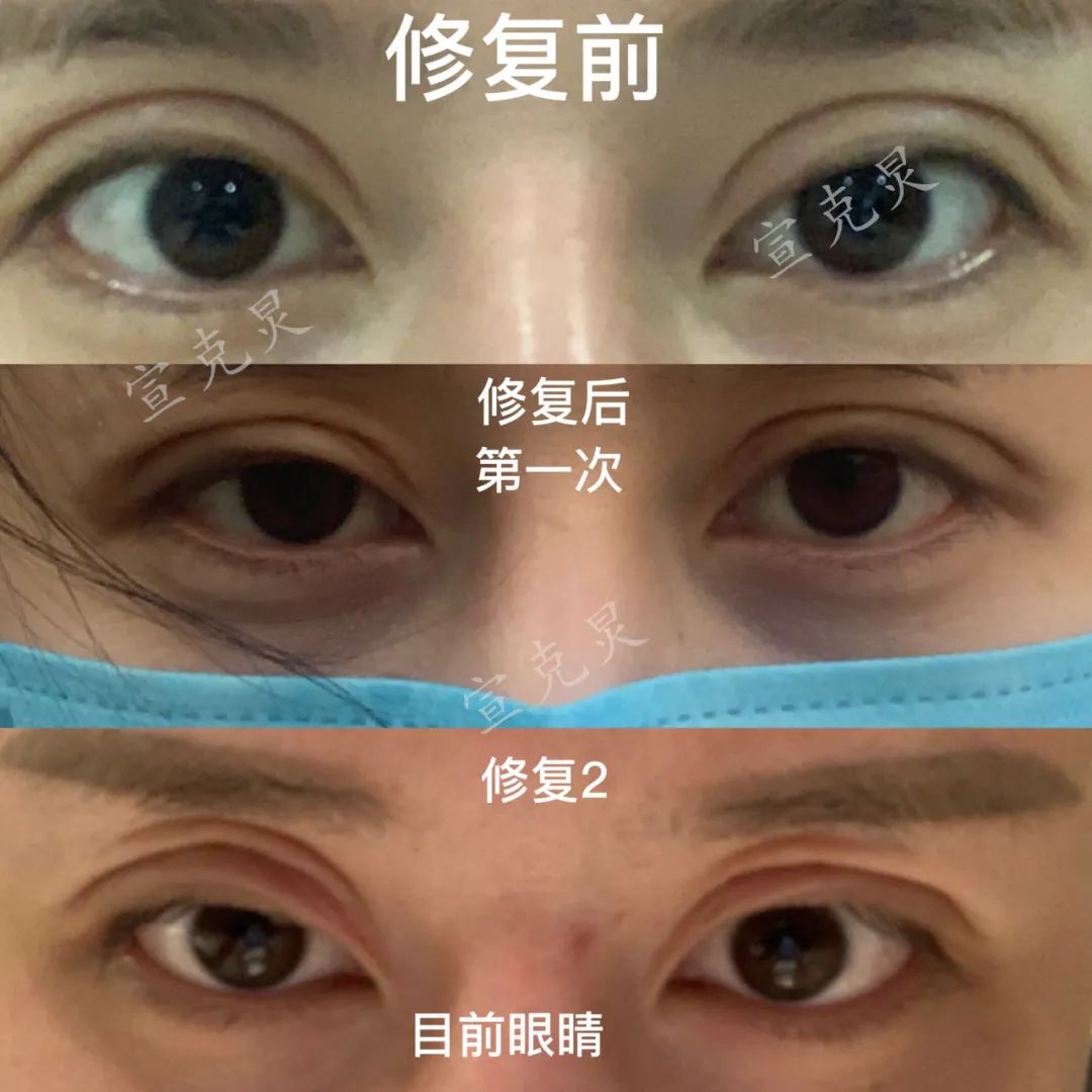 双眼皮整容毁容事件,整容毁容双眼皮