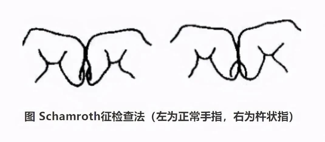 麦迪森健康提醒：手指末端莫名肿大！当心是疾病信号