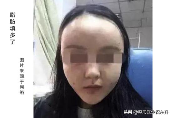 面部脂肪填充一个月皮肤的变化,面部脂肪填充的后脸部真的好了吗