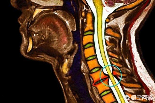治疗颈椎病眩晕的药物,颈椎病疼痛麻严重吗怎么治疗