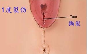 顺产什么情况会被侧切,顺产时候啥情况会引起大出血