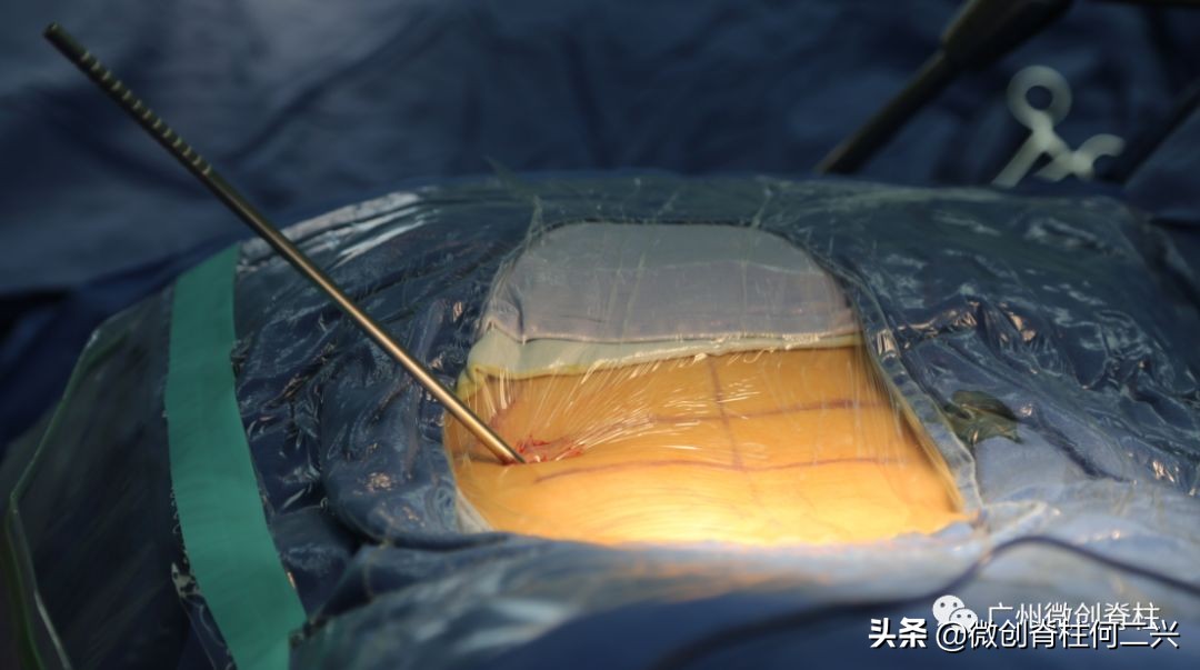 微创脊柱外科技术你知多少——全内窥镜下腰椎融合