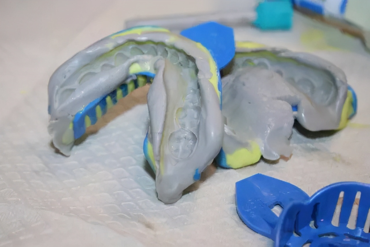 有多少人做了烤瓷牙后悔呀,为什么越来越多人放弃烤瓷牙