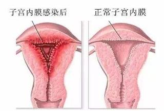 子宫内膜炎是什么原因引起的？该怎样确诊？