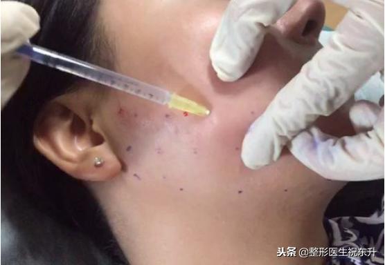 打溶脂针后悔,打溶脂针后悔一辈子