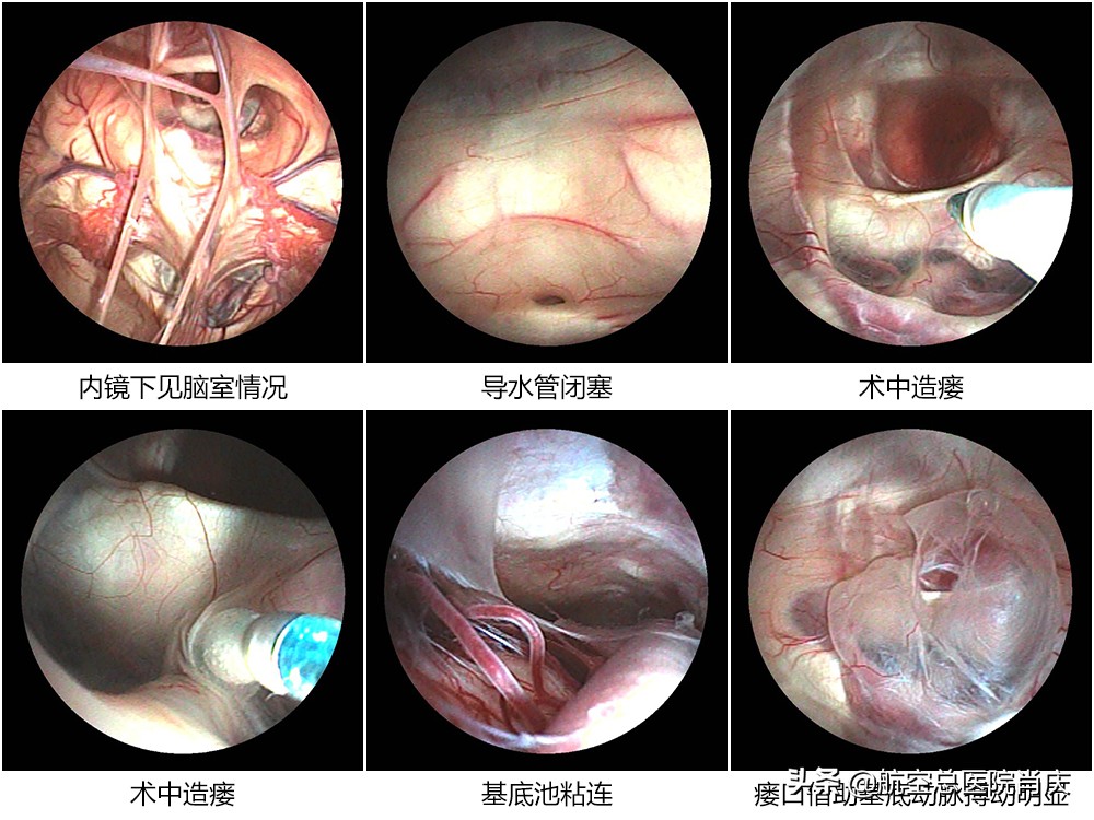 神经内镜微创治疗梗阻性脑积水