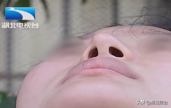 孕妈花高价垫鼻梁，不料术后歪成“蛇精脸”，医院：最多退4000