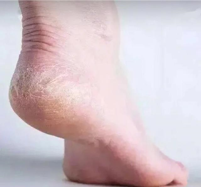 一招教你解决脚后跟干裂起皮,治理脚后跟干裂脱皮的小妙招
