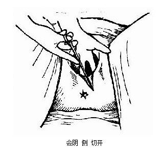 顺产什么情况会被侧切,顺产时候啥情况会引起大出血