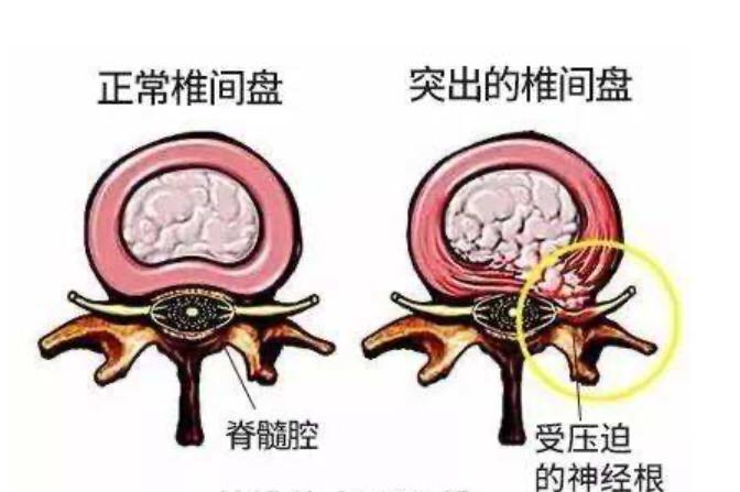 顽固性腰痛怎么治愈,困扰多年的腰疼问题终于搞清楚了