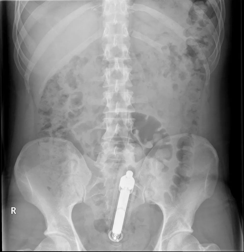 医生们曾在人体内取出过多少神奇的物件?