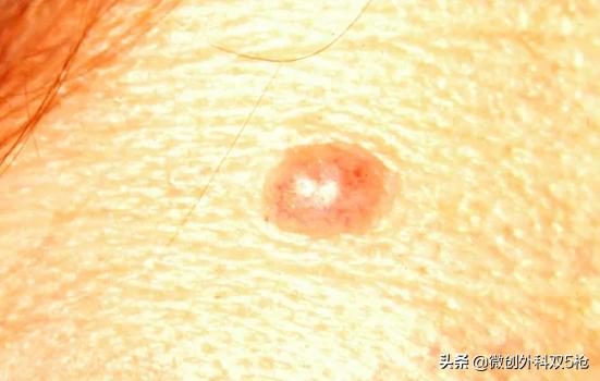 身上黑痔小心要了命！掌握ABCDE原则，教你肉眼判断黑色素瘤