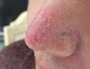 这令人烦心的酒糟鼻到底该如何应对？