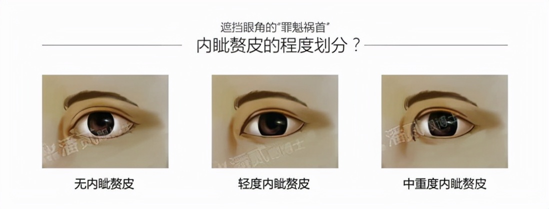 欧式大双眼皮和平行双眼皮,醒醒吧明智的放弃胜过盲目的执着