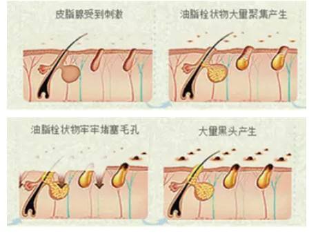 黑头没办法除根吗,黑头很难去除怎么办