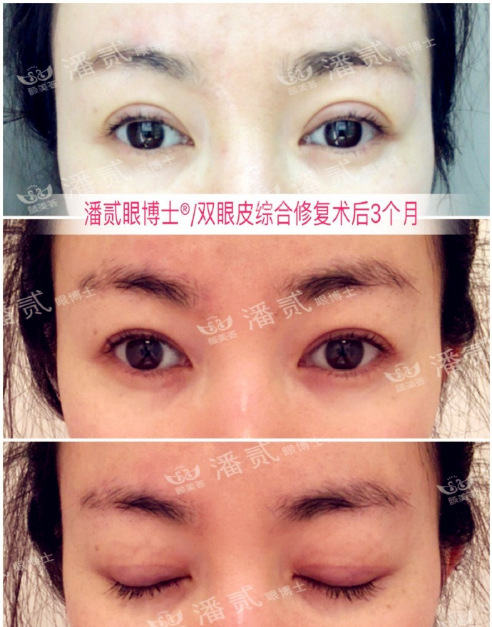 广州双眼皮修复内双,广州双眼皮修复可以只修眼尾吗
