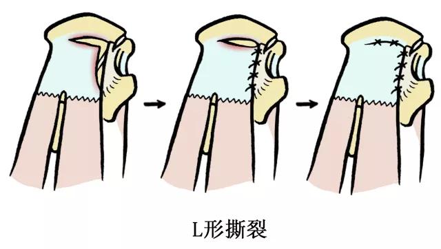 肩伤如何练肩,骨科专家教你肩袖康复训练